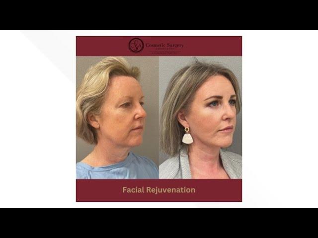 Cosmetic Surgery Associates share everything you need to know about facial rejuvenation