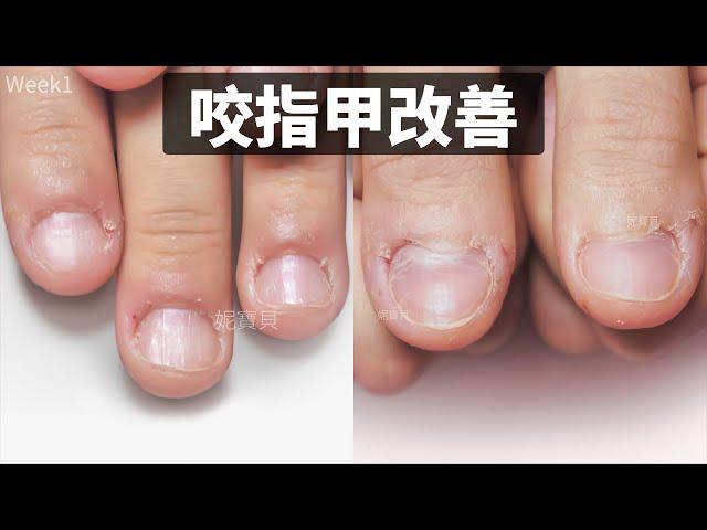 Improvement of nail biting｜Female medical student｜After-effects of nail damage treatment