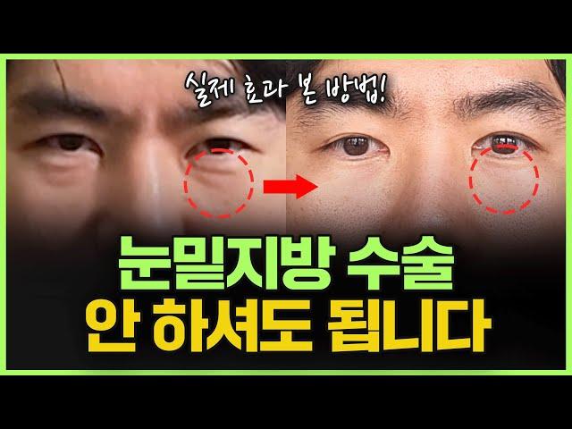 수술 없이 ‘눈밑 지방’ 없애는 법 | "바로 일상생활 할 수 있어요!"