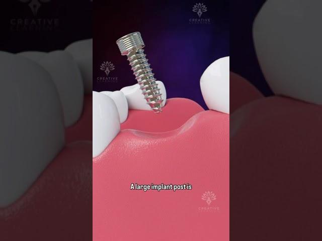 Bone Grafting for Dental Implants #shorts #facts - creativelearning3d