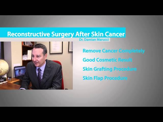 Skin Cancer Surgery Described by Sydney Plastic Surgeon Dr. Damian Marucci