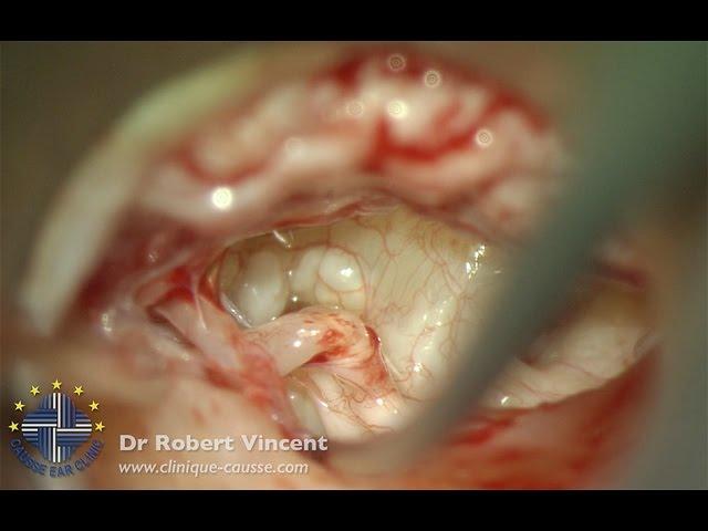 2nd stage tympanoplasty with stapedotomy for oval window tympanosclerosis - Dr Robert Vincent