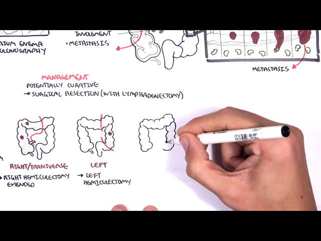 Colorectal Cancer - Overview