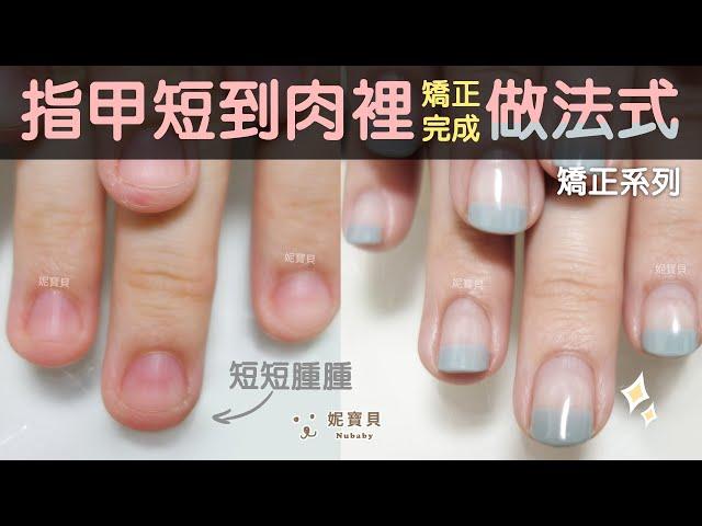 Problem nail correction-bite nails, remove nails, nails are short to the meat, correction is done