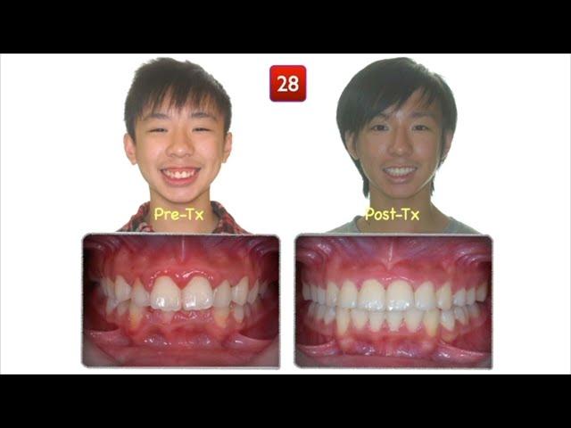 Class II, Deep Bite, Adult & Young｜【Chris Chang Ortho】CC572