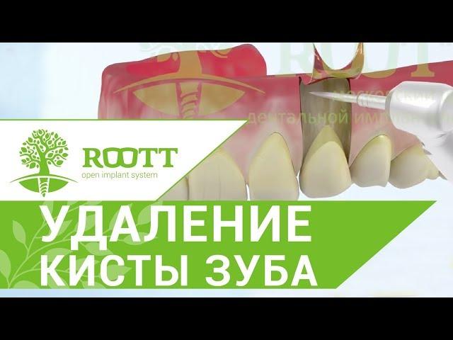 Удаление верхушки корня зуба  Безболезненное удаление верхушки корня зуба в ROOTT