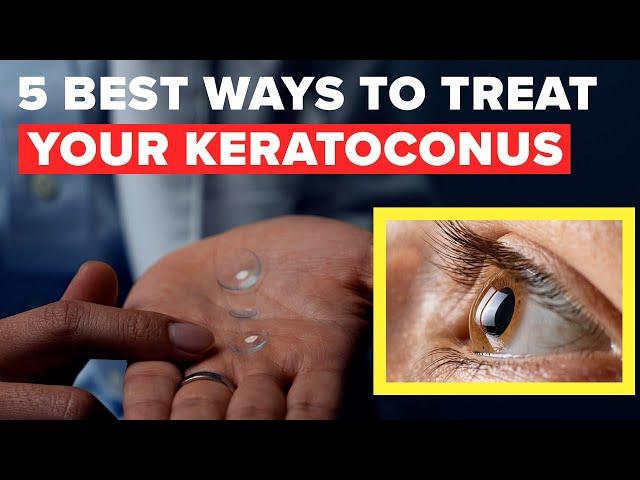 5 Best Ways to Treat Keratoconus Without Surgery