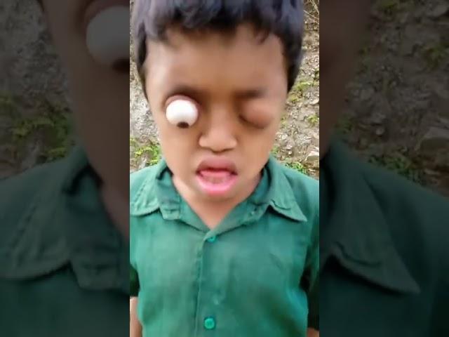 Cậu bé mắt lồi