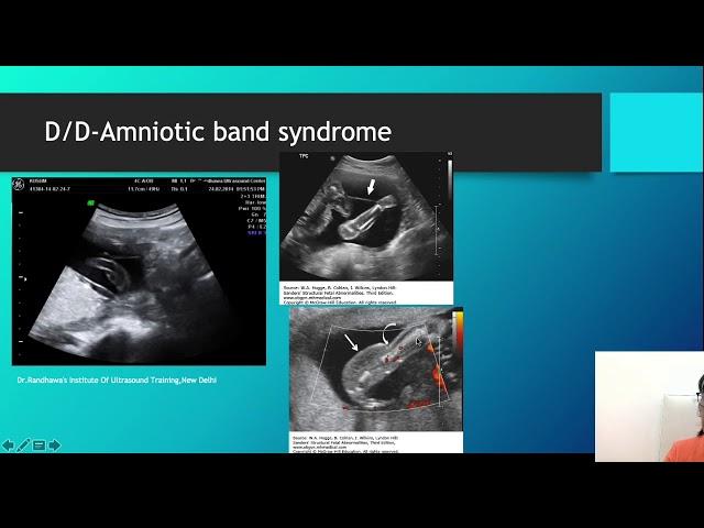 Amniotic sheet,band,circumvallate placenta,septum?