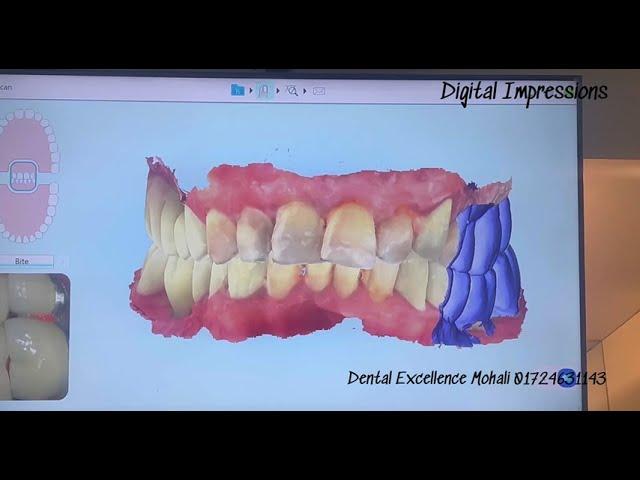 Digital Scans: The Future of Dentistry