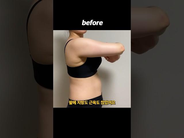 지방흡입 고민 중이라면 꼭 보세요 #shorts #비포애프터