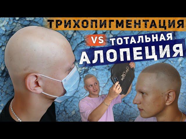 Трихопигментация vs Тотальная алопеция. Scalp micropigmentation by Andrey Afanasev