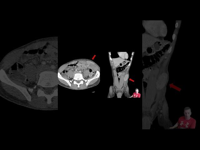 Spigelian Hernia #meded #emergencymedicine #generalsurgery #trauma #medstudent