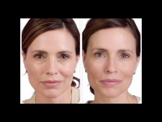 Non Surgical Facelift Liquid With Dermal Fillers #shorts #youtubeshorts #dermalfillers #medicalspa