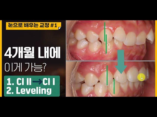 인비절라인 교정, 부작용 없이 치료기간 1년 줄이는 방법