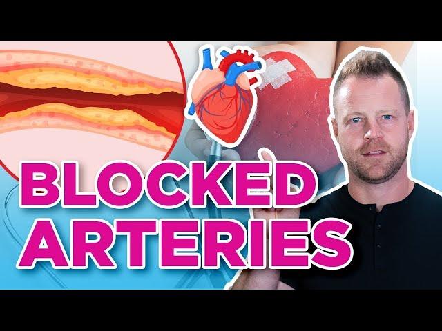 How To Prevent and Reverse Clogged Arteries | Heart Attacks