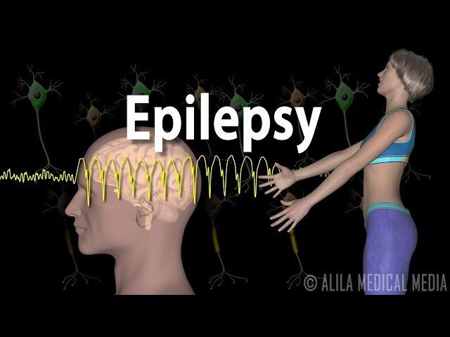 Epilepsy: Types of seizures, Symptoms, Pathophysiology, Causes and Treatments, Animation.