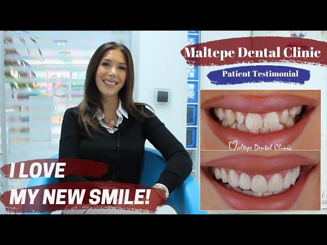 Veneer Treatment in Istanbul/Turkey | Maltepe Dental Clinic