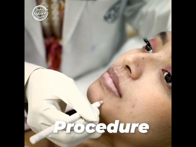 Lip fillers procedure | lip fillers shorts | #Shorts | #YouTubeShorts