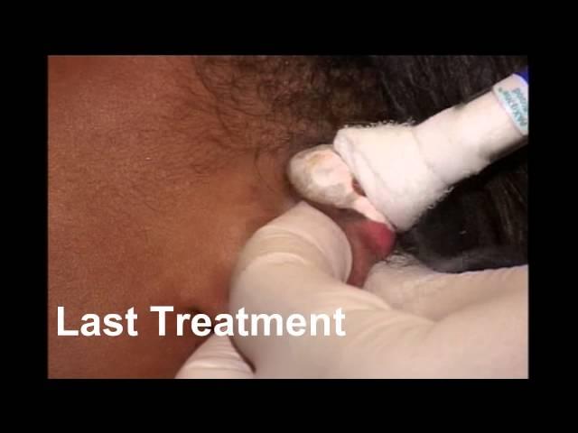 Ear Keloid treatment with CryoTherapy by keloid specialist Dr  Michael Tirgan, New York