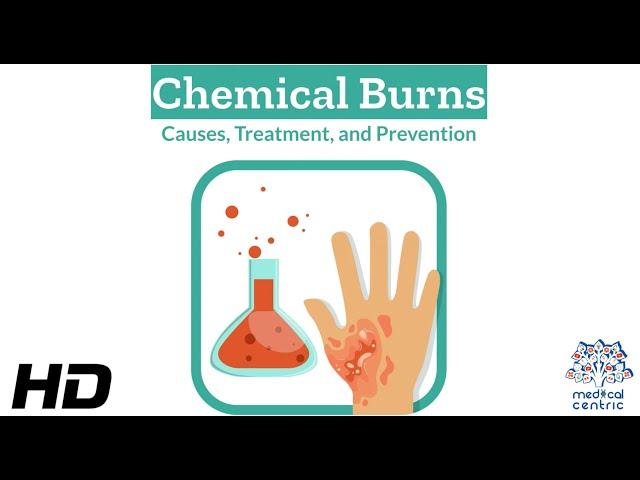 Burned by Chemicals: A Deep Dive into Causes, Treatment, and Avoidance