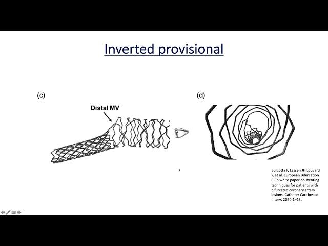 Practice Tips with Dr. Lichaa: Simplifying Coronary Bifurcation