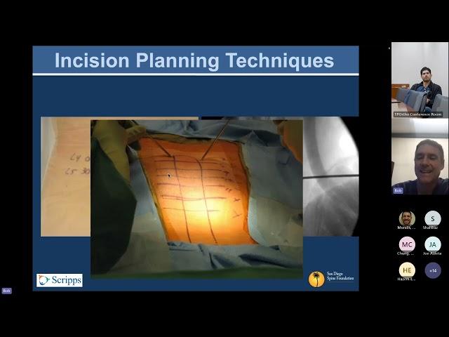 Surgical Approach for Percutaneous Screw Placement presented by Robert K. Eastlack, MD