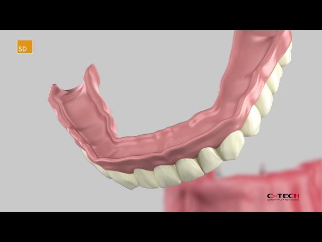 SD Small Diameter - Surgical Protocol