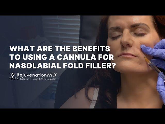 Cannula Artistry: Transforming Nasolabial Folds with Filler