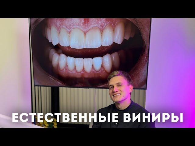 Естественные виниры