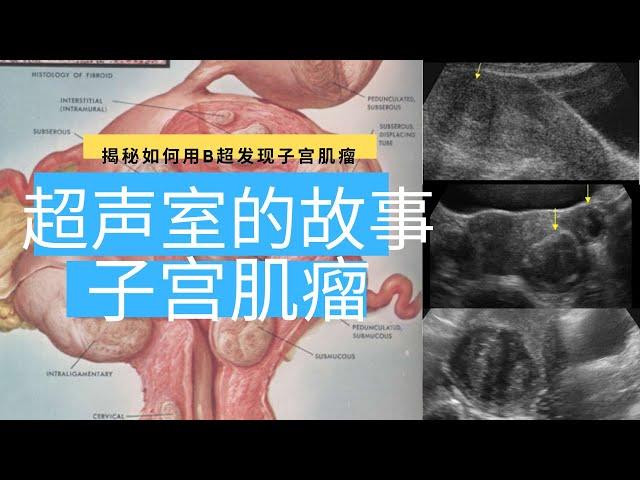 超声室的故事: 子宫肌瘤 【Ultrasound Room】Diagnosing Uterine Fibroids on Ultrasound