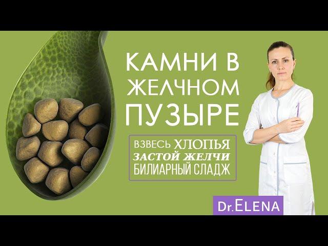 ЖКБ. Камни в желчном пузыре. Билиарный сладж, застой желчи, хлопья в желчном пузыре. УДХК | Урсосан.