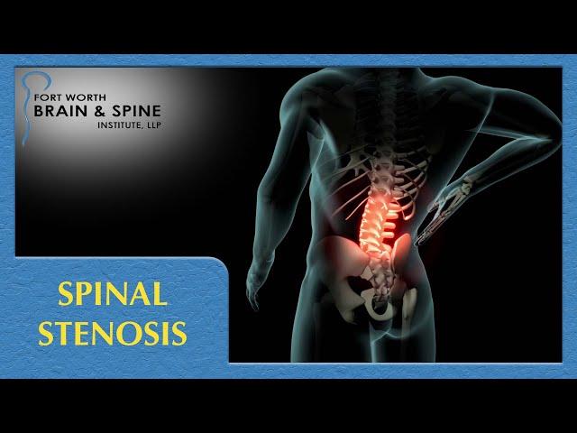 Fort Worth Brain and Spine Institute - Spinal Stenosis