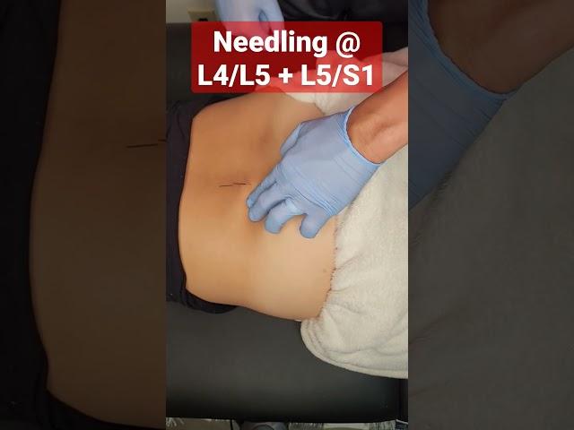 Dry needling the lower back for back + hip pain/tension! #dryneedling #ims #physio #backpainrelief