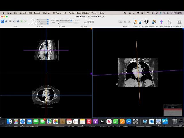 DICOM viewer for Apple - Using Horos