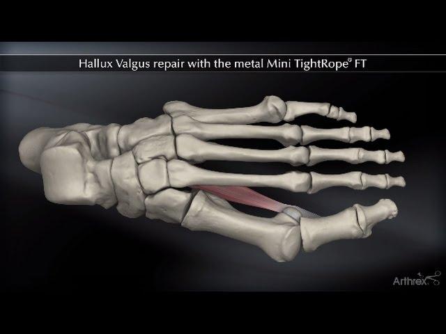 Hallux Valgus Repair with the Metal Mini TightRope® FT