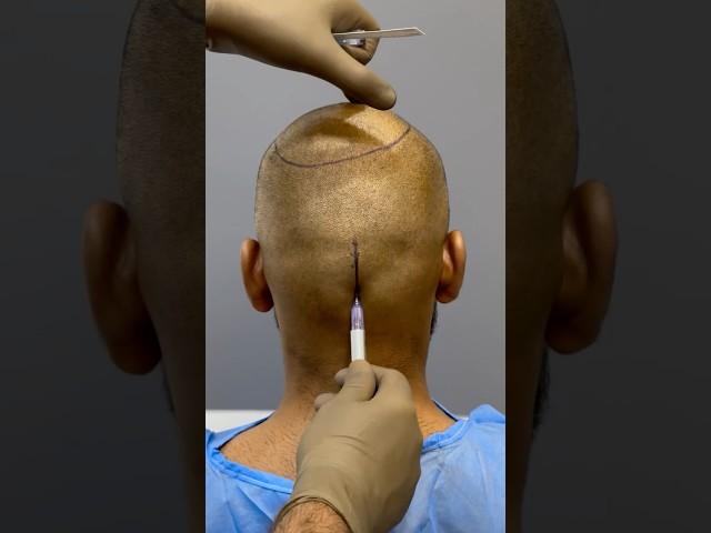 MIND-BLOWING Hair Transplant Surgery | Latest Fue Technique #shorts #viral #hair