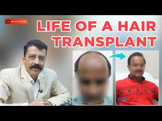 Life of Hair Transplant | Is Hair Transplant Permanent | Causes & Precautions | By Dr Arvind Poswal