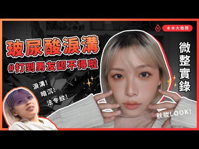 【玻尿酸實錄】打完淚溝超後悔？！怎麼現在才鼓起勇氣！ feat.彩妝師Ginger