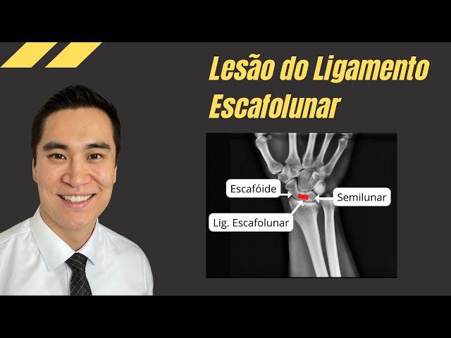 Dangerous and silent! Injury of the scapholunate or scapholunate ligament