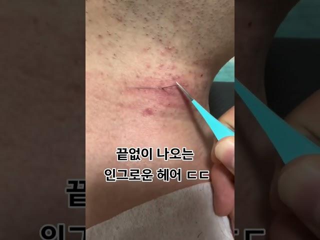 끝 없이 나오는 인그로운 헤어 ㄷㄷ..