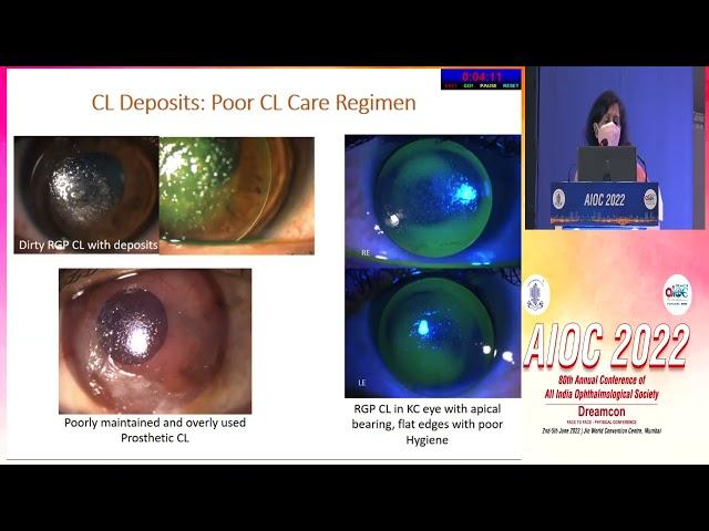 AIOC2022 IC118 Topic Dr  Mrs  RADHIKA TANDON  Contact lens associated corneal emergencies