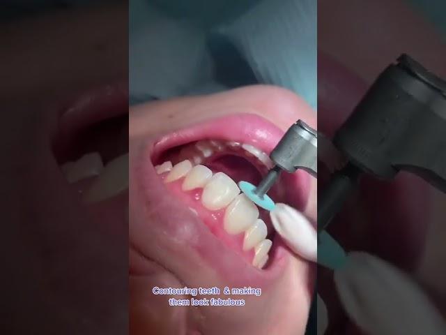 This is how we do it  #bonding #composite #teeth #dentist #dentistry #contouring #teethwhitening