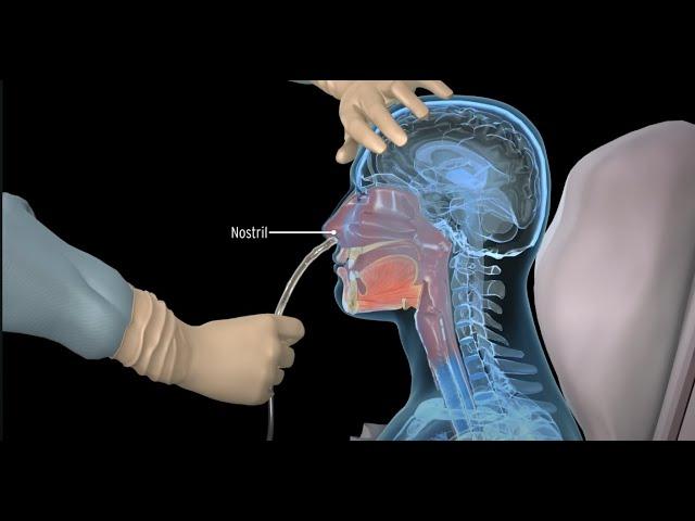 How to insert a nasogastric tube for NG intubation - 3d animation