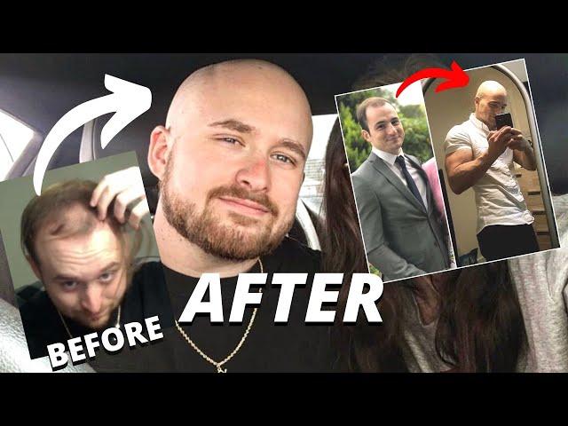 BALDING TO BALD GLOW UPS - THE ULTIMATE TRANSFORMATIONS - Part 1