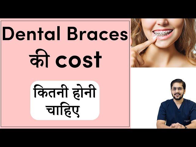 Cost of teeth braces | दांतों के ब्रेसिज़ का खर्च | Dental Braces price in Indore