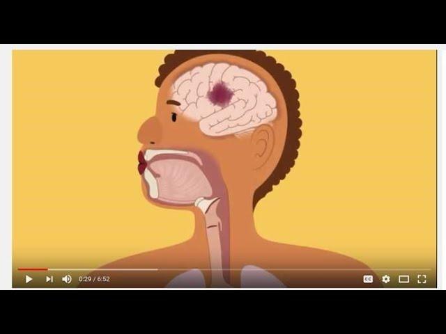 Swallowing and Communication after Stroke