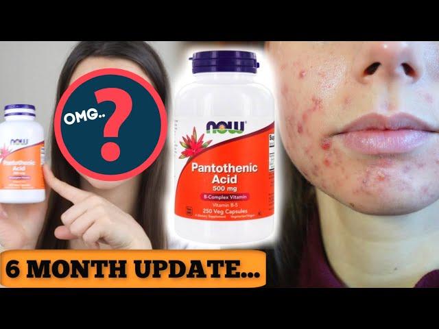 I TOOK PANTOTHENIC ACID FOR 6 MONTHS.. HERE IS THE UPDATE. || Did B5 get rid of cystic acne fast?