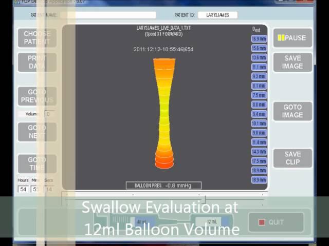 Distensibility Testing of the Pharyngo-Esophageal Segment using EndoFLIP