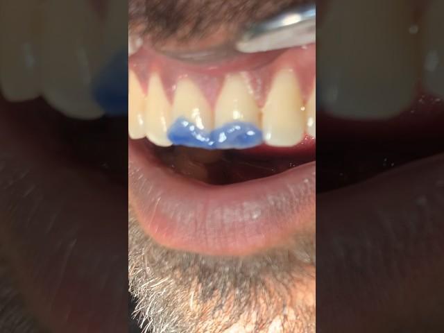 Smoking cause stains ruined smile #dental #dentistry #viral #youtube#umairtoothfairy⁠@Umairazeem8553